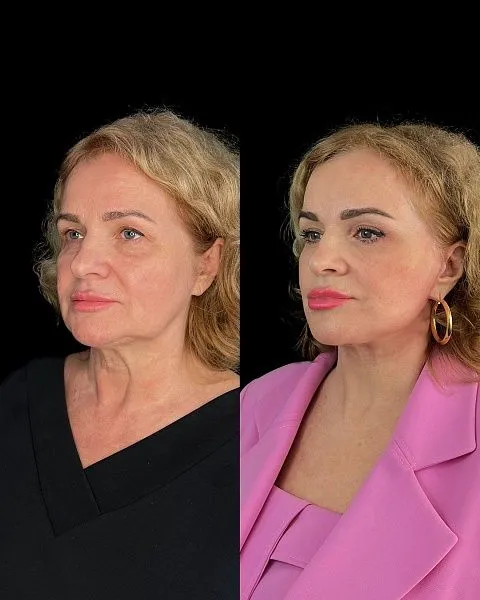 Блефаропластика