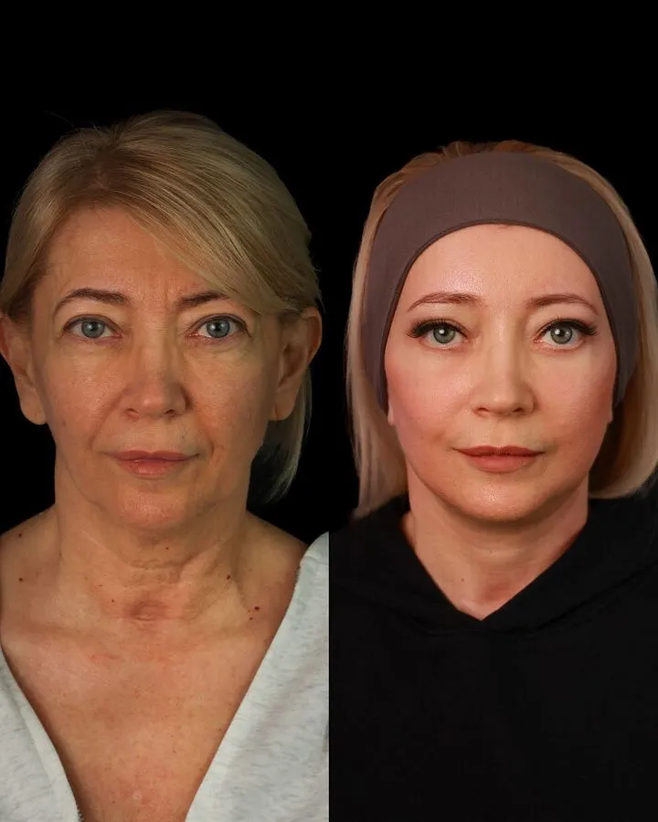 До/после операции