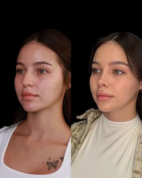 Ринопластика