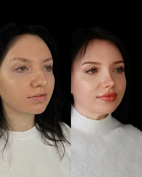 Ринопластика