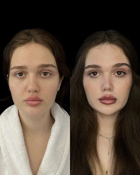 Ринопластика