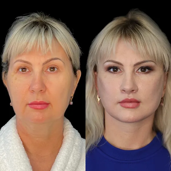 Пластика лица и шеи