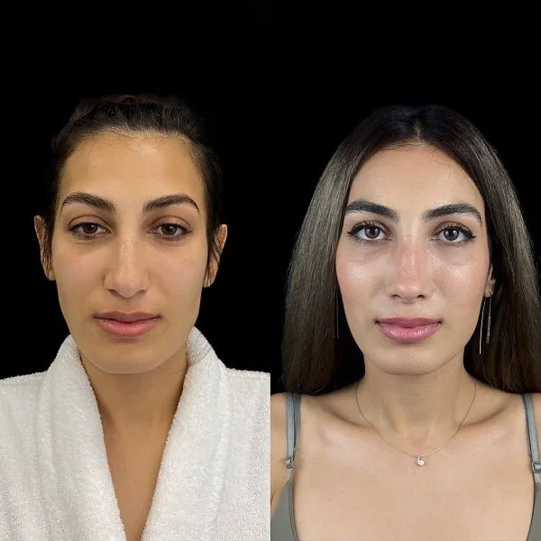 Ринопластика