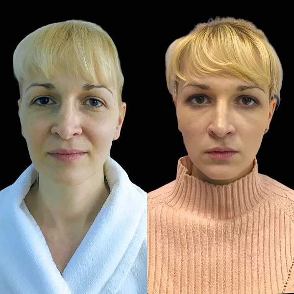 Пластика лица и шеи