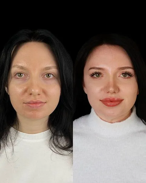 Ринопластика