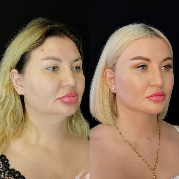Пластика лица и шеи