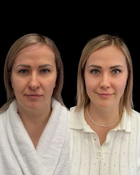 Ринопластика