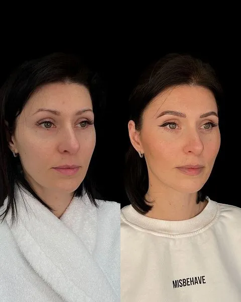 Блефаропластика