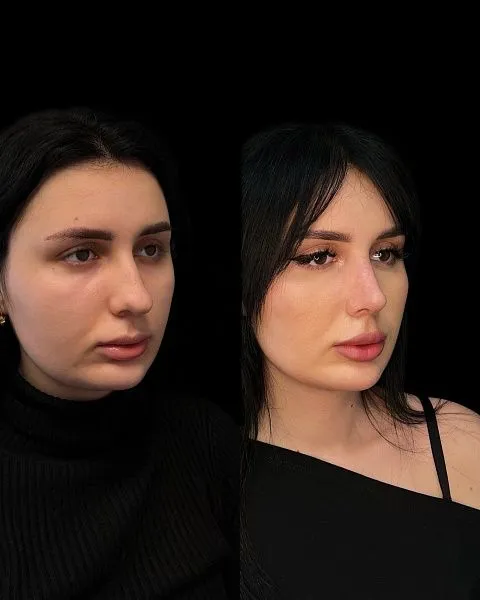 Ринопластика
