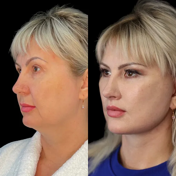 Пластика лица и шеи