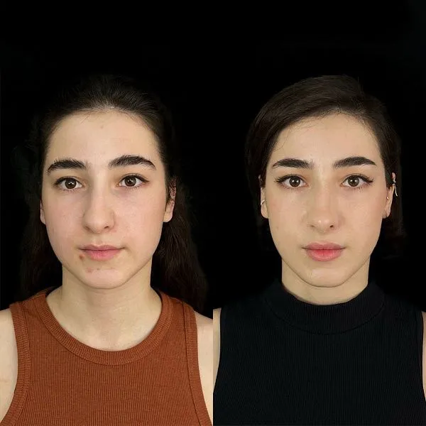 Ринопластика