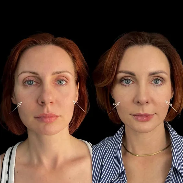 Инъекционная косметология