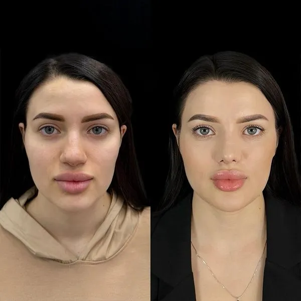 Ринопластика