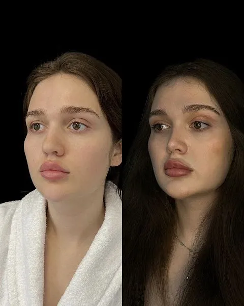 Ринопластика