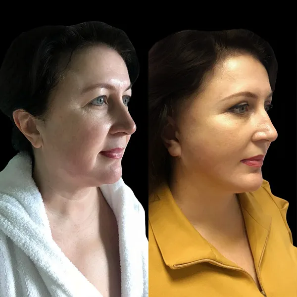 Пластика лица и шеи