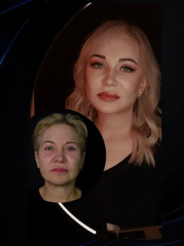 SMAS-подтяжка лица