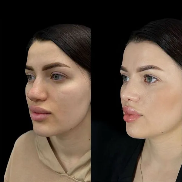 Ринопластика