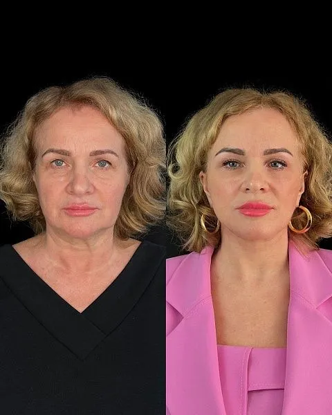 Блефаропластика