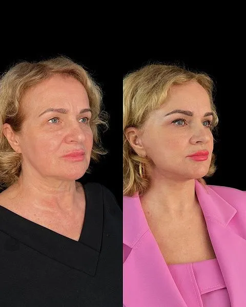 Блефаропластика