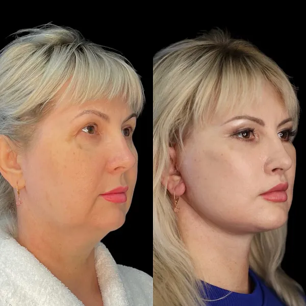 Пластика лица и шеи