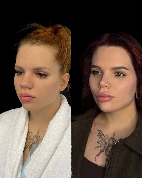 Ринопластика