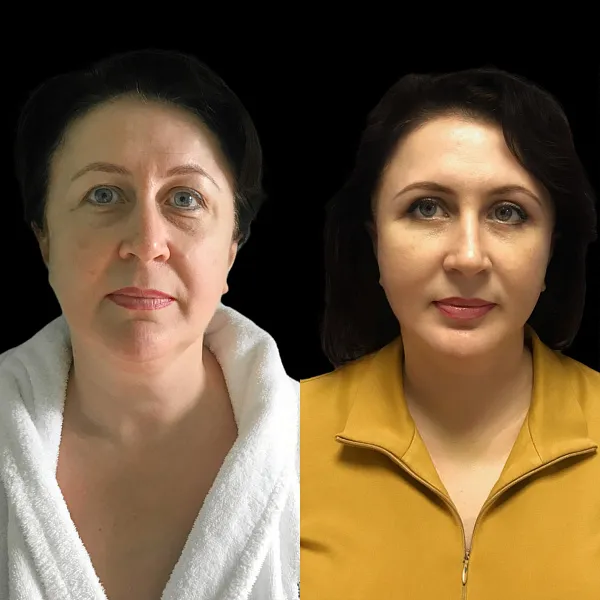 Пластика лица и шеи