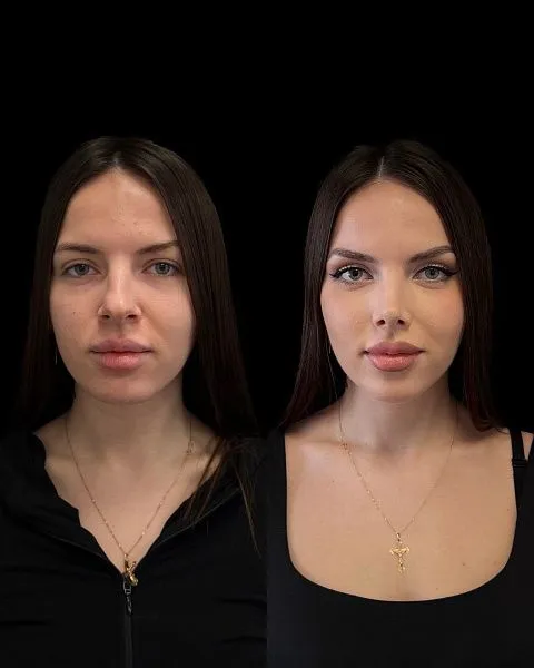 Ринопластика