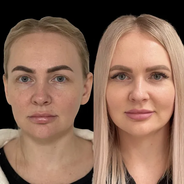 Пластика лица и шеи