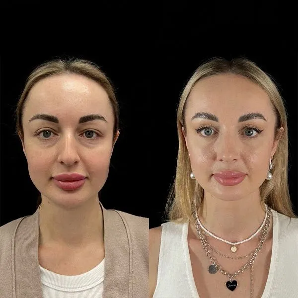Ринопластика