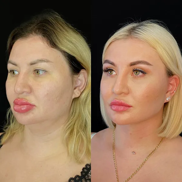 Пластика лица и шеи