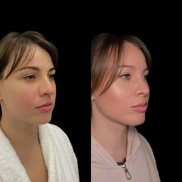 Ринопластика
