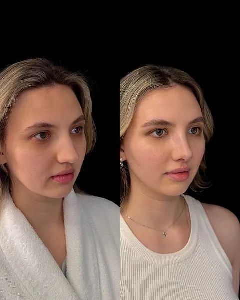 Ринопластика