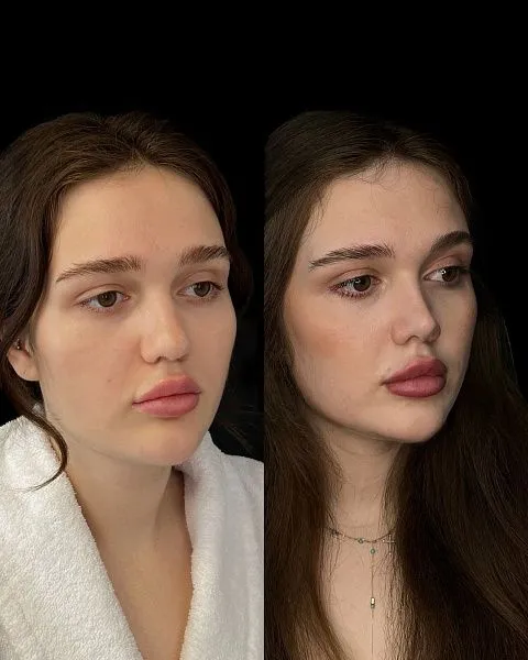 Ринопластика