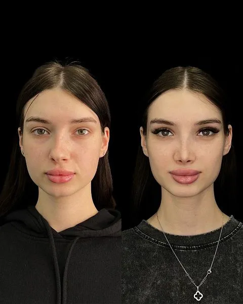 Ринопластика