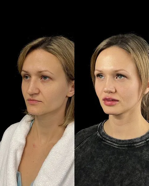 Ринопластика
