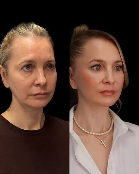 Блефаропластика