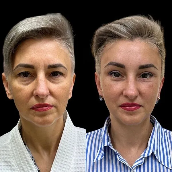 Блефаропластика