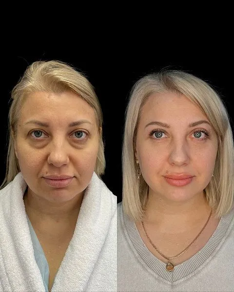Блефаропластика