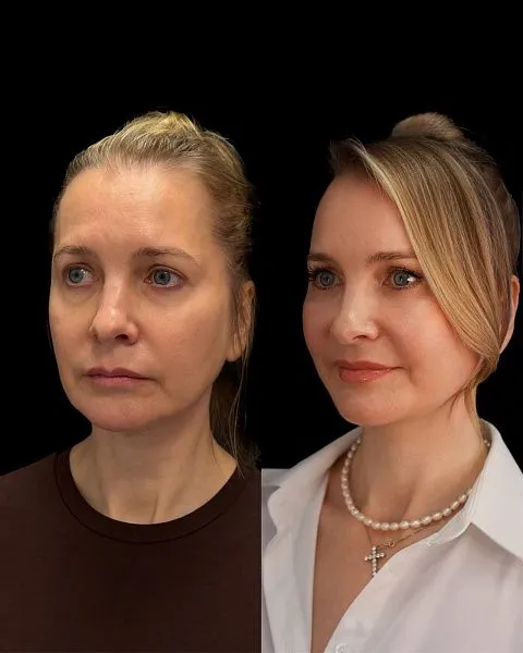 Блефаропластика