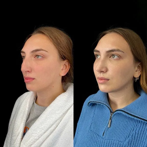 Ринопластика