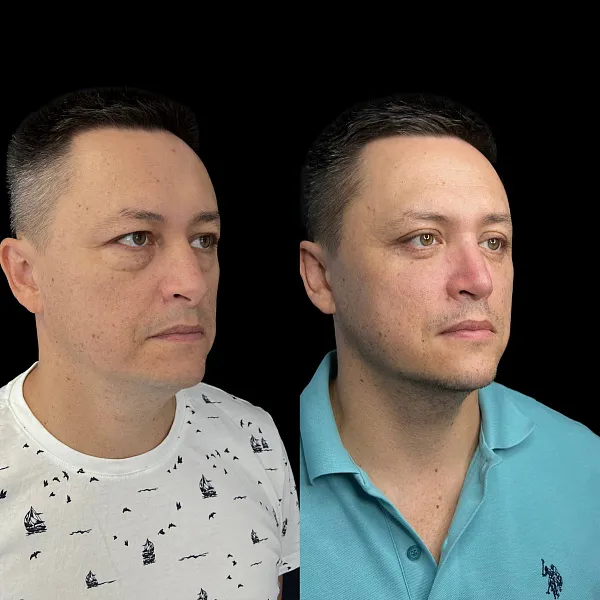 Блефаропластика
