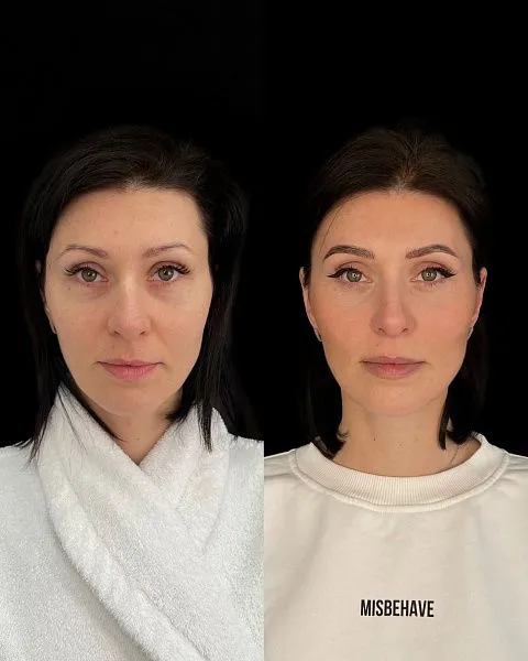 Блефаропластика
