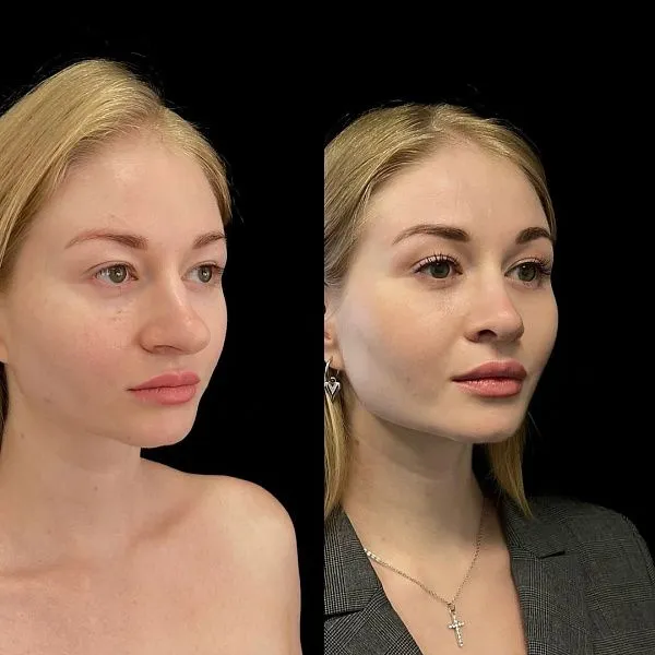 Ринопластика