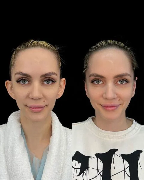 Отопластика