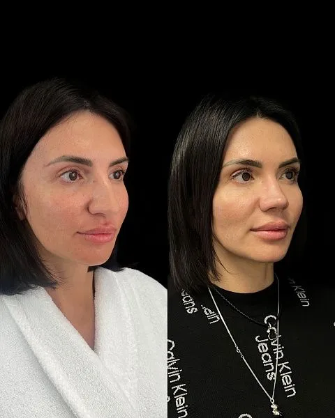 Ринопластика