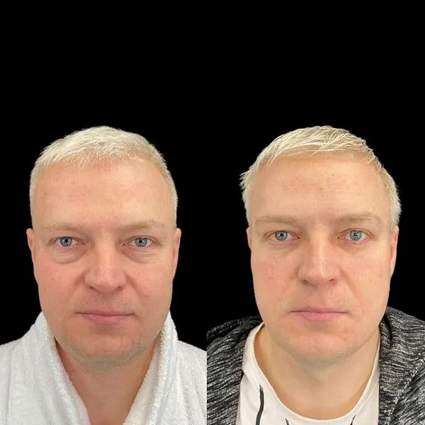 Блефаропластика