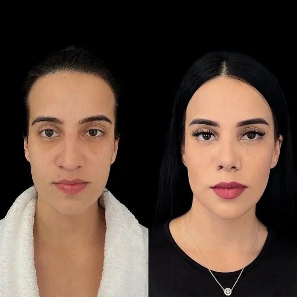 Ринопластика