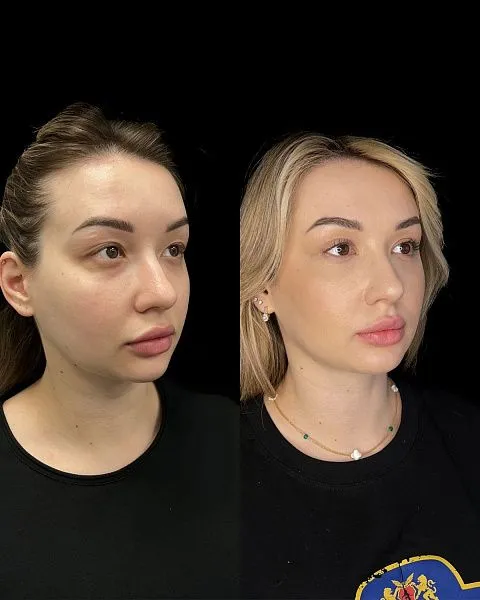 Блефаропластика