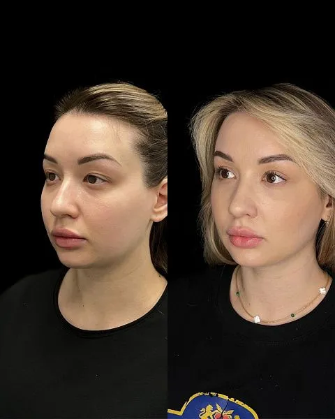Блефаропластика
