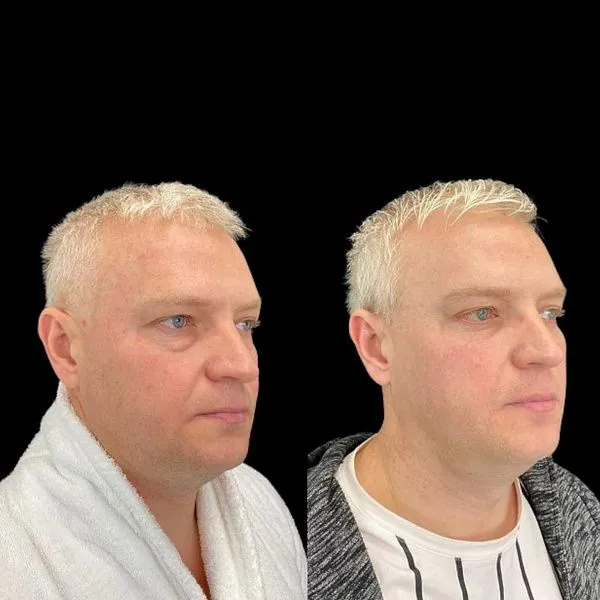 Блефаропластика